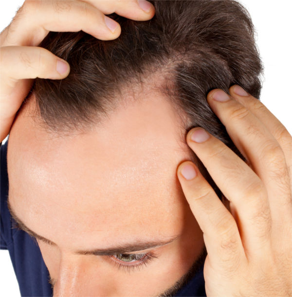 alopecia-soluzioni