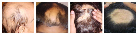 alopecia-areata-2