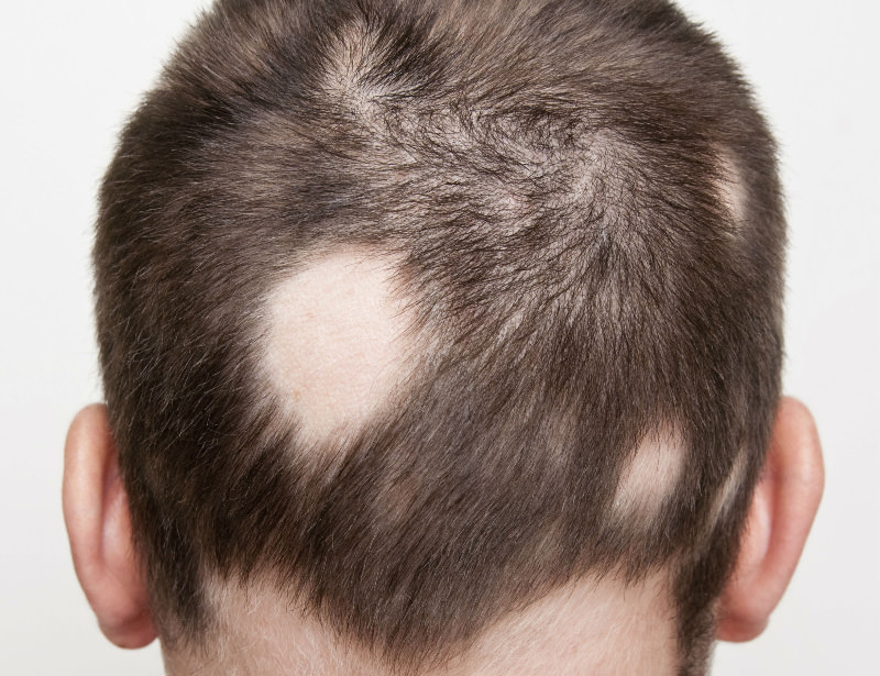 alopecia-areata