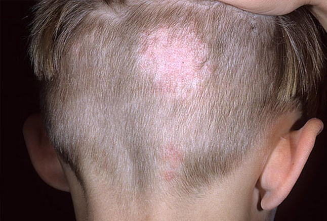 dermnet_photo_of_ringworm_on_scalp