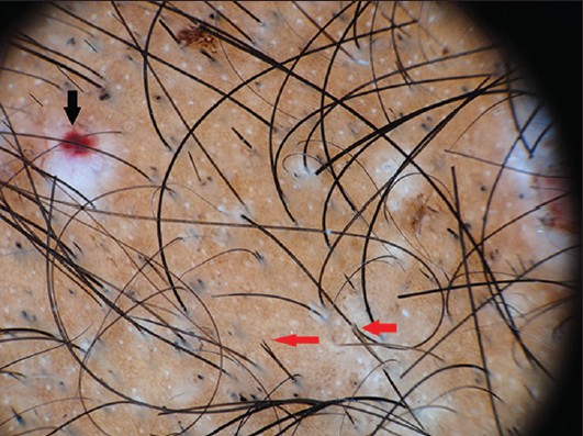trciotilomania