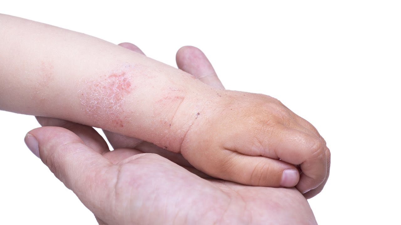 dermatita alergică între degete)